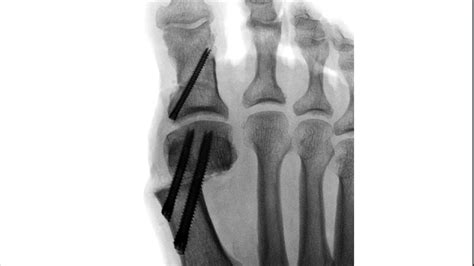 Arthrex Arthrex Minimally Invasive Bunionectomy Surgical Technique