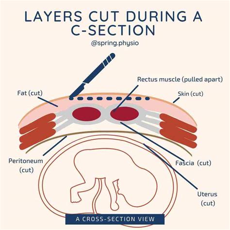 Layers Cut During A Caesarean C Section