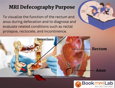 Mri Defecography Price Purpose Procedure Results