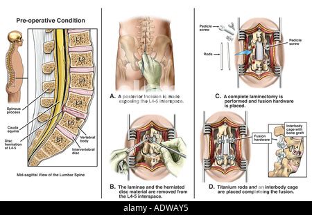 Lumbar Disc Herniation L4 5 With Surgical Laminectomy And Discectomy