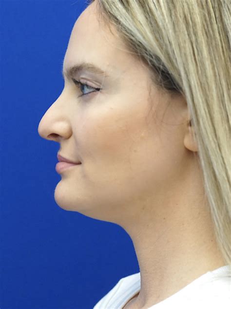 Cases In Rhinoplasty Revision Mao Facial Plastics