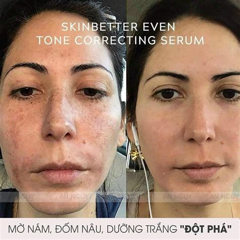 Tinh Chất Làm Giảm Nám Sáng Da Skinbetter Science Even Tone Correcting