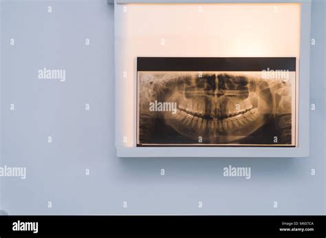 Analyzing Dental X Ray Tooth X Ray In Viewer On The Wall Stock Photo