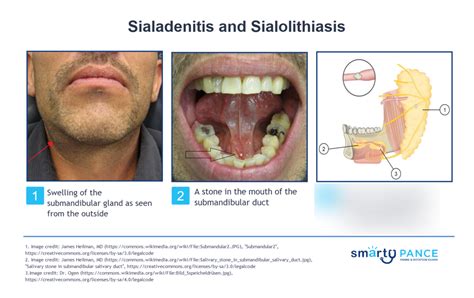 Sialadenitis Diagram | Quizlet