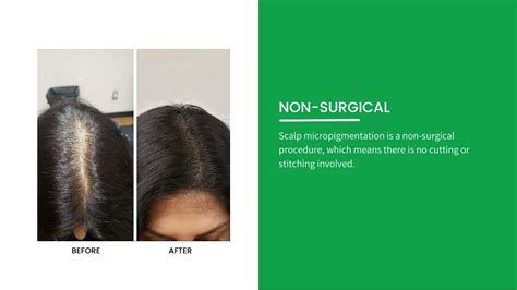 Ppt Advantages Of Scalp Micropigmentation Hair Ensure Powerpoint