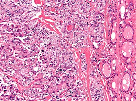 Advances in Thyroid Cancer Research - NCI