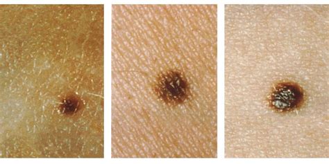 How to check mole on skin for cancer - Business Insider