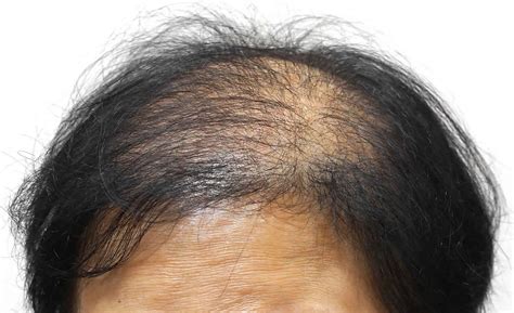 Female Pattern Baldness Causes Treatment And More Justinboey