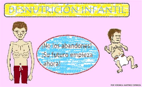 DesnutriciÓn Infantil DesnutriciÓn Infantil