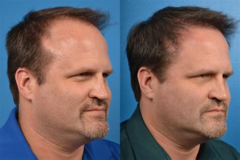 Hair Restoration Photos Melbourne Fl Patient 57533