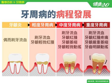 牙周病／牙周病能根治嗎？如何診斷及治療？治療後1件事絕不可輕忽病程進程類型