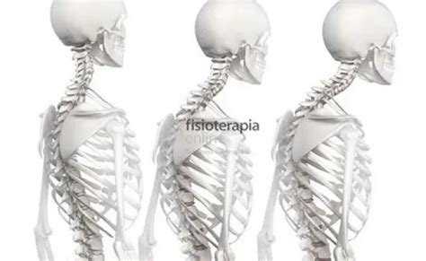 Hipercifosis Dorsal Que Es Causas Sintomas Diagnostico Y Otosection