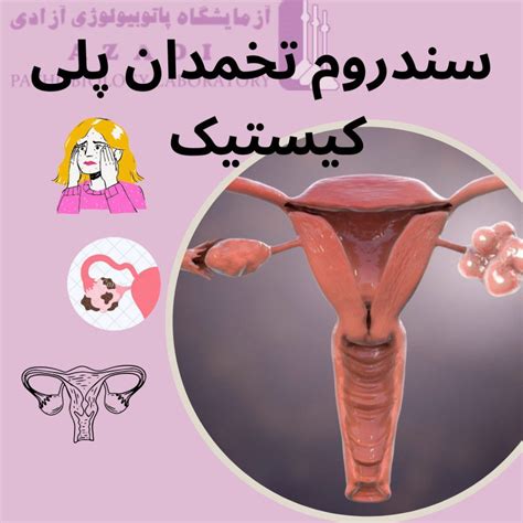 سندروم تخمدان پلی کیستیک یا PCOS آزمایشگاه پاتوبیولوژی آزمایشگاه