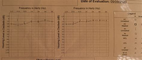 Distorted hearing but normal hearing tests results - Hearing Loss ...