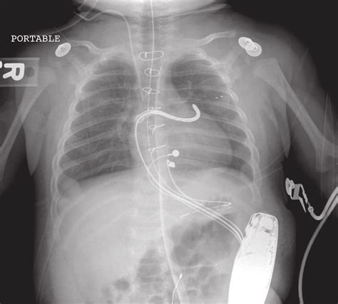 Implantable Cardioverter Defibrillator X Ray