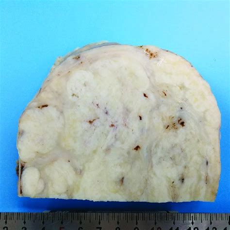 Section View Of Subserosal Leiomyoma Showing Typical Nodular Firm And