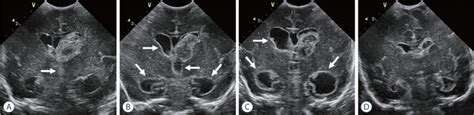 Neuroimaging Of Germinal Matrix And Intraventricular Hemorrhage In