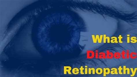 Can Diabetic Retinopathy Be Reversed Retinopathy Symptoms Youtube