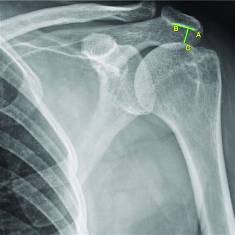 Anteroposterior Shoulder Radiography Demonstrating Center Equator Download Scientific Diagram