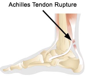 Achilles heel injury part 2