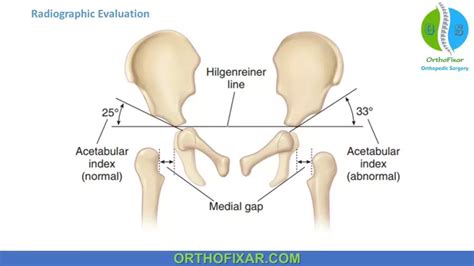 Developmental Dysplasia Of The Hip Orthofixar