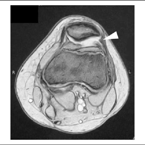 The Formation Of A Plica Like Structure Was Observed In The Lateral