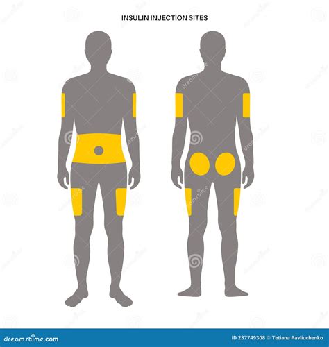 Injection Sites Suitable For An Insulin Injection Cartoon Vector | CartoonDealer.com #343857269