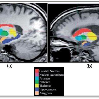 Sub cortical segmentation of MRI scans, after boundary correction, of ...