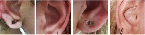 Earlobe Repair Solent Vascular Care