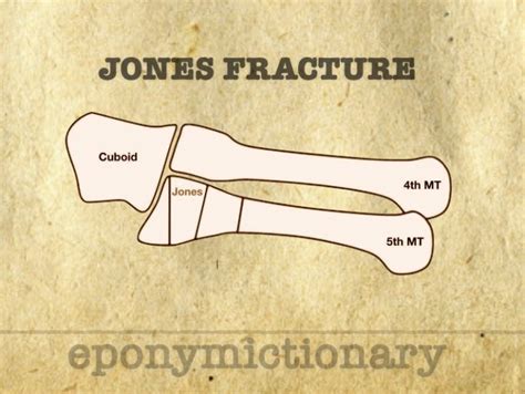 Jones Fracture Archives • LITFL