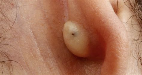 Lumps Bumps Bumps Pimples Swelling Behind The Ear Pain Behind The