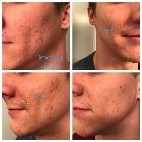 Chemical Peel Process | Radiant Skin Spa