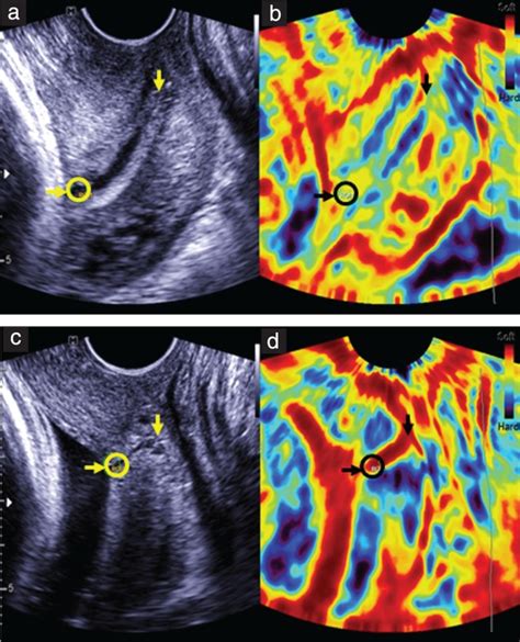 Successful Induction Of Labor Prediction By Preinduction Cervical