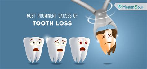 The Most Prominent Causes Of Tooth Loss – Healthsoul