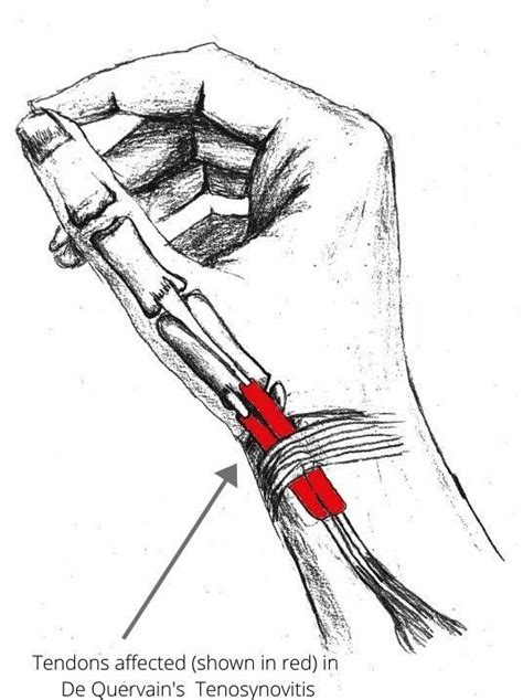 De Quervain’s Tenosynovitis Specialised Hand Therapy