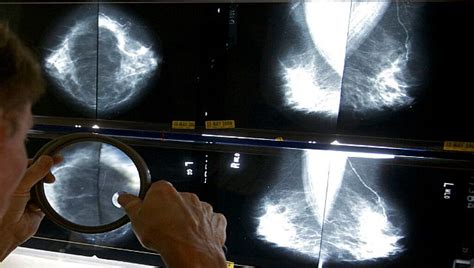 How Breast Tissue Density Can Help In Detecting Breast Cancer Risk