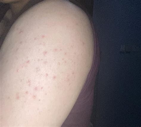 How do I get rid or reduce my shoulder acne? It’s on both sides : r/acne