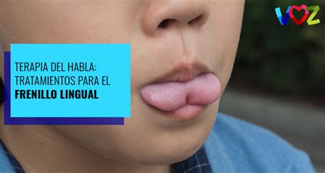 Terapia del habla: Tratamientos para el frenillo lingual | El Instituto