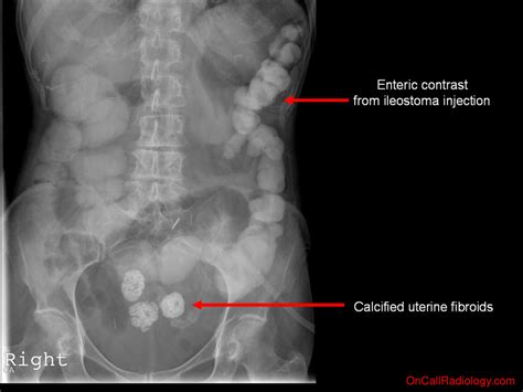 On Call Radiology Common Radiology Findings On Call And In The