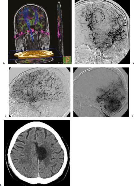 Treatment Of An Arteriovenous Malformation In Eloquent Areas Neupsy Key