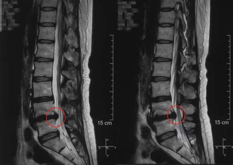 腰椎间盘突出伴发腰椎管狭窄一次孔镜轻松解除双重危机