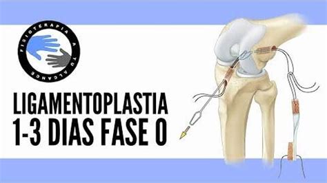 Ligamento Cruzado Anterior Fisioterapia A Tu Alcance