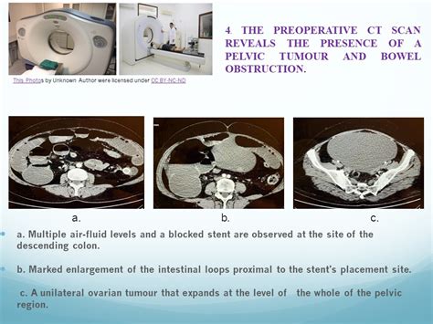 Case Presentation of Krukenberg Tumour – MD Sinziana Ionescu