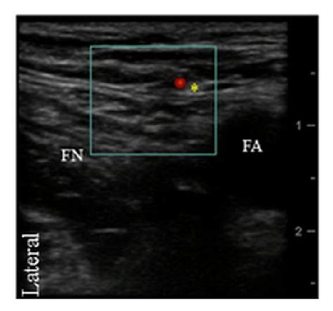 Transverse Ultrasound Image Of The Lateral Femoral Cutaneous Nerve Download Scientific Diagram