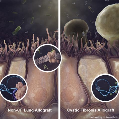 Cystic Fibrosis Lung Transplant Recipients Have Suppressed Airway