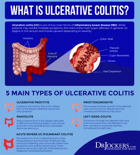 Ulcerative Colitis Causes Symptoms And Support Strategies