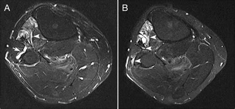 Case Of Intraneural Ganglion Cyst Of The Common Peroneal Nerve Reported Download Scientific