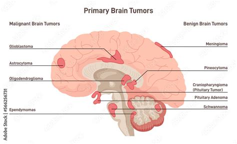 Brain cancer concept. Primary brain tumors types. Malignant cells ...