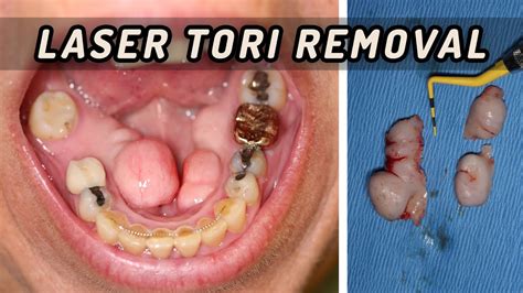 Laser Tori Removal Youtube