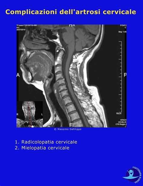 Artrosi Cervicale I Sintomi E La Fisioterapia Fisioterapia Rubiera